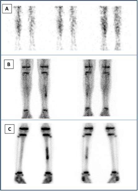 a. Three-phase bone scan from the legs: Upper row (A): anterior images ...