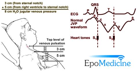 Physical Examination: Jugular Venous Pulse and Pressure (JVP) | Epomedicine