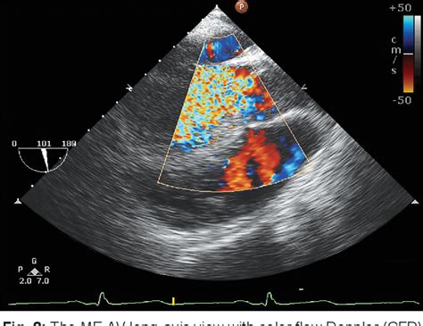 Figure 2 from Perforation of Bicuspid Aortic Valve mimicking Trileaflet ...