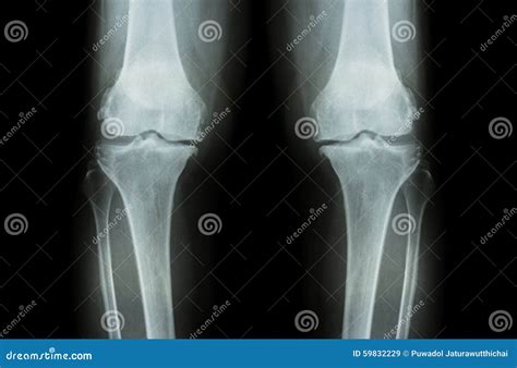 Osteoarthritis Knee ( OA Knee ). Film X-ray Both Knee ( Front View ...