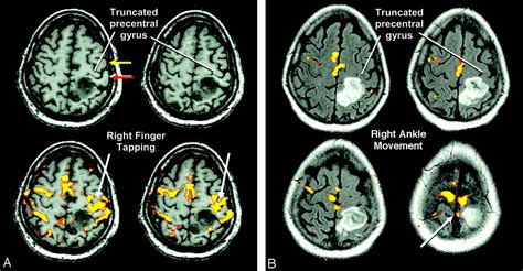 Superior Frontal Gyrus Mri