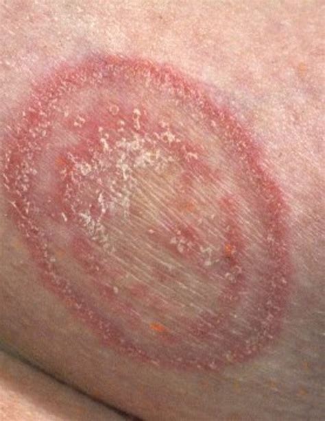 Natural Fungal Infection Treatment With Essential Oils | HubPages