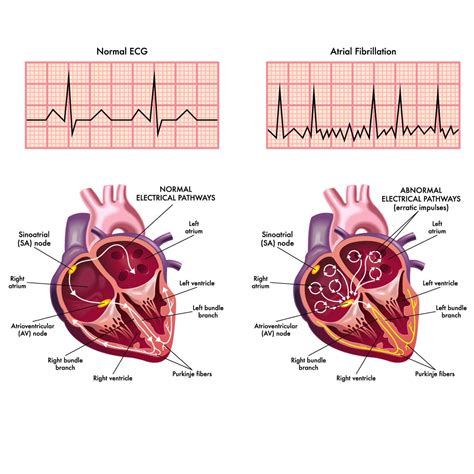 Atrial Fibrillation: Symptoms, ECG, Causes, Treatment,, 59% OFF