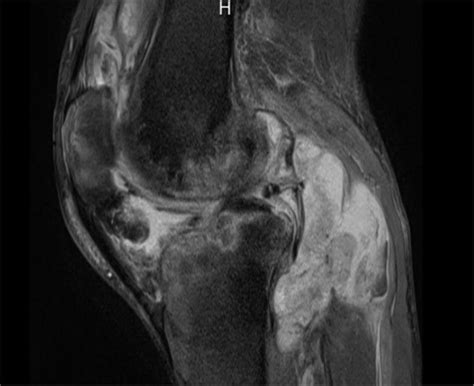 : MRI demonstrating large complex joint effusions and bone marrow edema ...