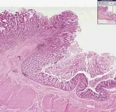 Adenocarcinoma Colon Histology