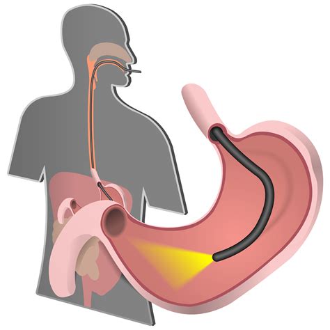 Upper GI Endoscopy – Adirondack Gastrointestinal & Colorectal Surgery