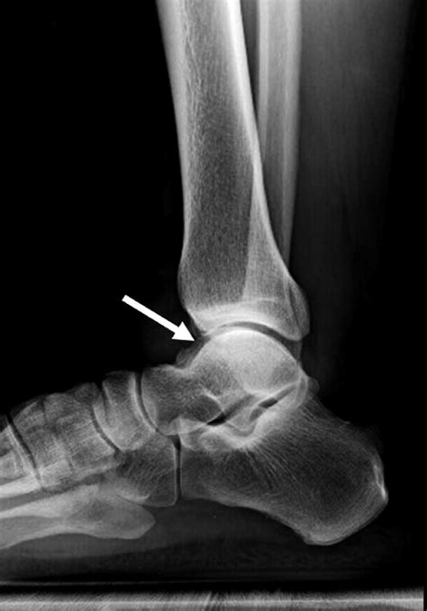 Ossicles associated with chronic pain around the malleoli of the ankle ...