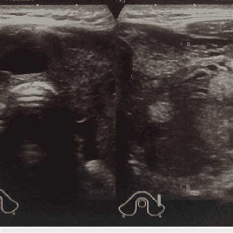 Patient's thyroid ultrasound upon diagnosis showing multinodular goiter ...