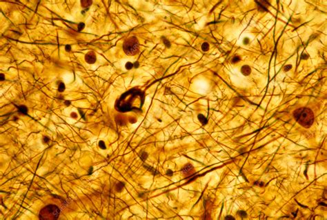 Neurofibrillary tangles in pyramidal neuron, light micrograph - Stock ...