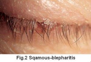 sqamaous-blepharitis - The Ultimate Guide To Blepharitis