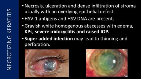 Viral Keratitis: Diagnosis, Management and Latest Guidelines