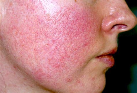 Acne Rosacea Causes and Diagnose – The Natural Cure