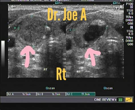 Ultrasound imaging: MNG-or-multinodular-goiter