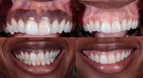 Gum Depigmentation and Bleaching Los Angeles | LA Periodontists