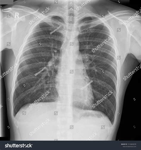 Normal Chest Plain Radiography Xray Film Stock Photo 1514840078 ...