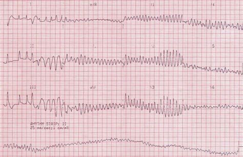 Ventricular Fibrillation (VF) • LITFL • ECG Library Diagnosis