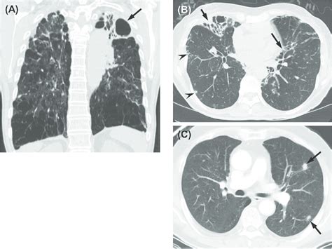 Diverse patterns in images of M. kansasii lung disease. (A) A ...