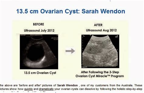 Nsg Dx: Health Up: Ovarian Cyst Miracle by Carol Foster