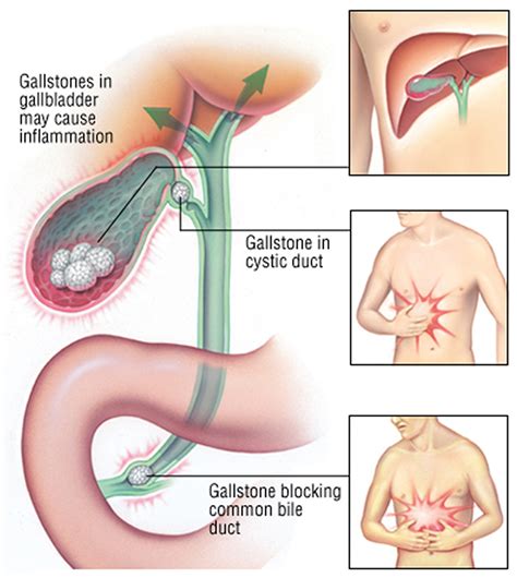 Gallbladder Pain & Problems - Causes, Symptoms, Diganosis, Treatment