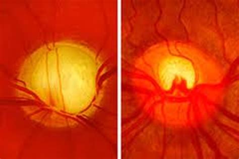 The Optic Nerve in Glaucoma | IntechOpen