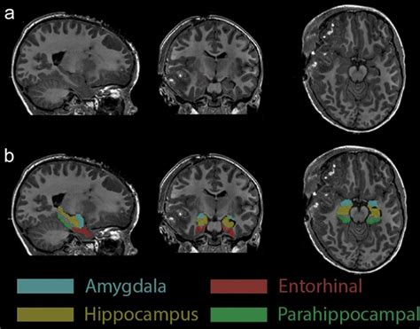 Amygdala and surrounding structures on anatomical MRI. a A ...