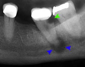 Radiografia de abscesso periapical: como acontece? | Dabi Atlante