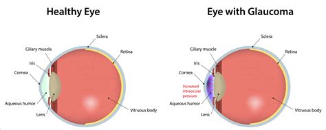 Narrow Angle Eye Condition