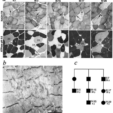 Morphological features of hereditary inclusion body myopathy in one ...