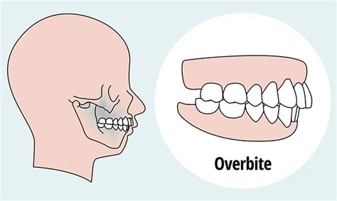 I Have an Overbite – What Treatment Should I Use? - HD Orthodontics