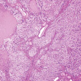 A biopsy of the thyroid tissue proved to be a metastasis of lung ...