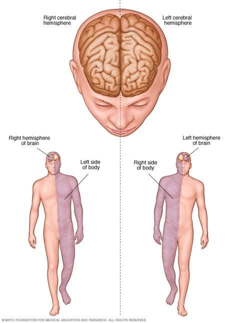 Stroke - Diagnosis and treatment - Mayo Clinic