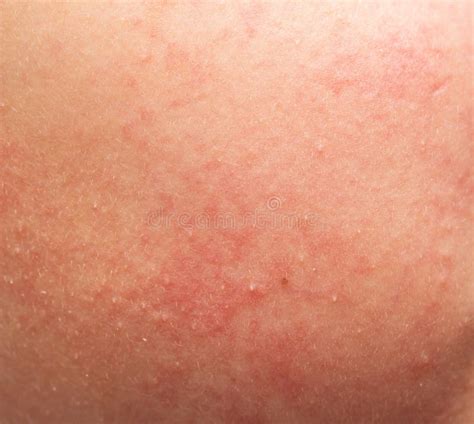 Skin Allergy in the Form of Rash Stock Photo - Image of appearance ...