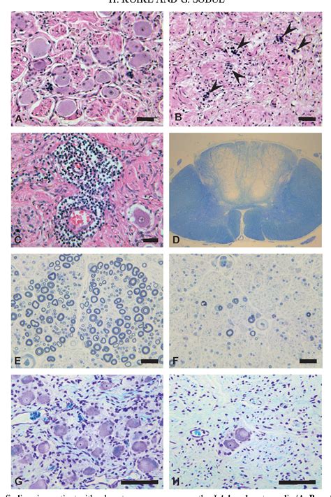 Figure 41.1 from Paraneoplastic neuropathy. | Semantic Scholar