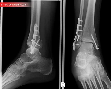 Fibula and Tibial Fracture | Rehab My Patient