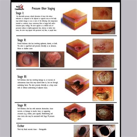 Wound stages | Pressure ulcer staging, Nursing study, Pressure ulcer