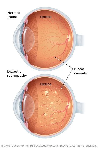 Diabetic retinopathy - Symptoms and causes - Mayo Clinic