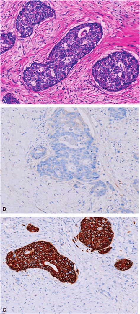 Histological findings of the tumor of the spleen. (A) Moderatelypoorly ...