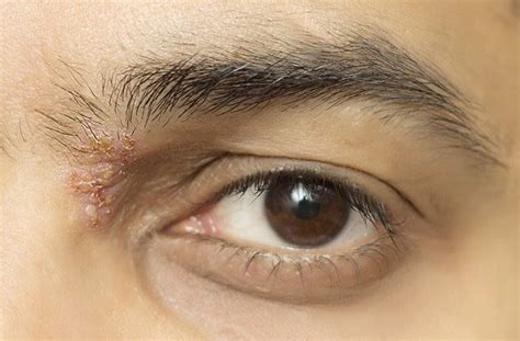 Shingles In the Eye (Ocular Shingles): Symptoms and Treatments