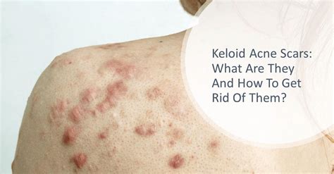 Keloid Acne Scars: What Are They And How To Get Rid of Them? | Dream ...