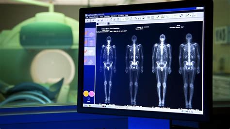 DEXA BONE DENSITY SCAN - CAROLINA RADIOLOGY