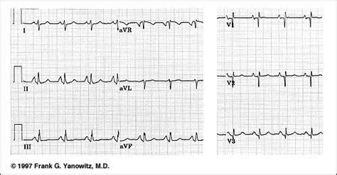 Atrial Enlargement On Ekg