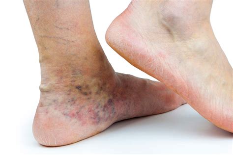 Venous Dermatitis: Untreated Varicose Vein Complications | Vein Health