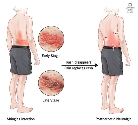 Postherpetic Neuralgia: Symptoms, Causes, Treatment & Prevention