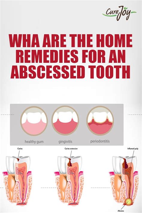 Incredible Home Remedies Abscess Tooth References