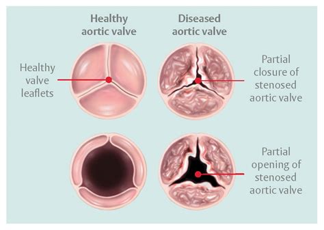 Aortic Valve Anatomy A Complete Exploration MD, 56% OFF