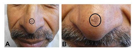 Cureus | Pigmented Actinic Keratosis: Case Report and Review of an ...