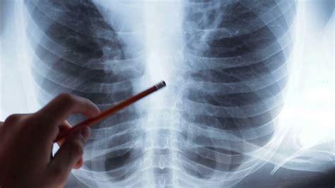 A picture of an X-ray of healthy lungs. Doctor studying mri patient's ...