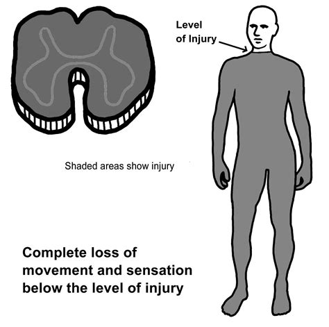 What happens to the spinal cord? | University of Iowa Hospitals & Clinics