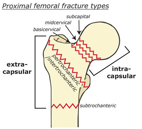 Femoral neck fracture causes, types, symptoms, diagnosis, treatment ...