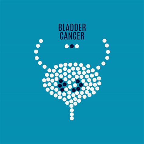 Bladder Cancer | Manchester Urology Associates, PA